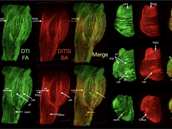 DiTSI Human Brainstem