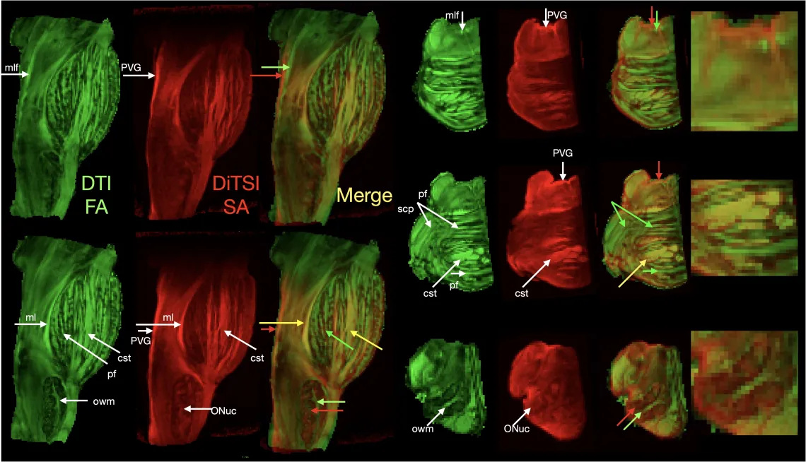 DiTSI Human Brainstem