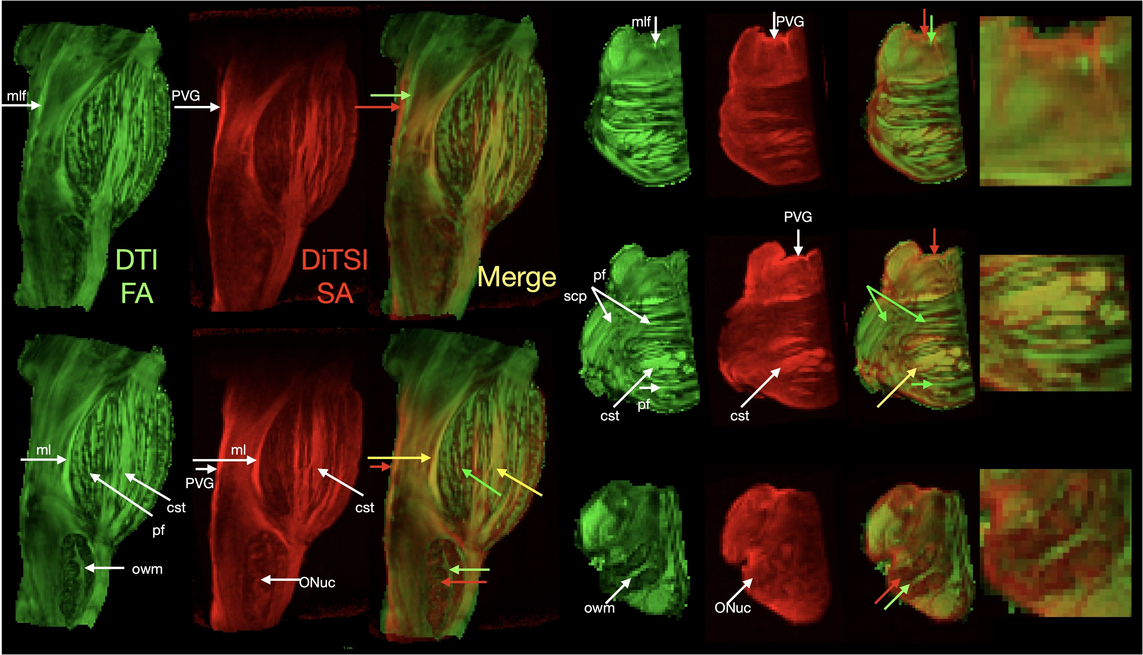 DiTSI Human Brainstem